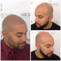 Micro Scalp Clinic